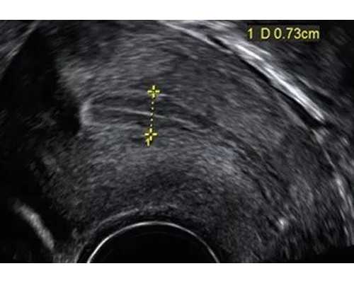 天津家圆医院供卵_拉拉裤勒肚子怎么办