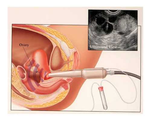如何养出又圆又大的卵泡，提高试管婴儿成功率？