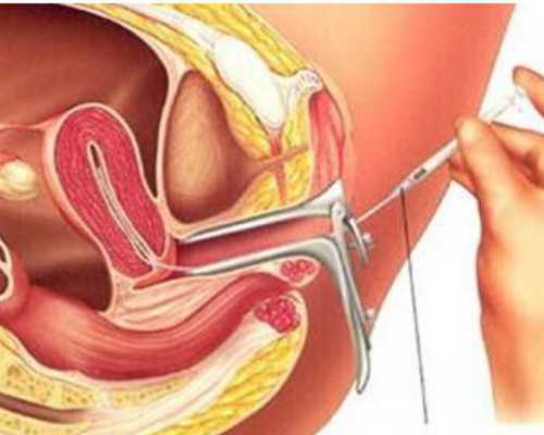 正规生殖医院提供代妈_当归金银花汤真能助孕吗