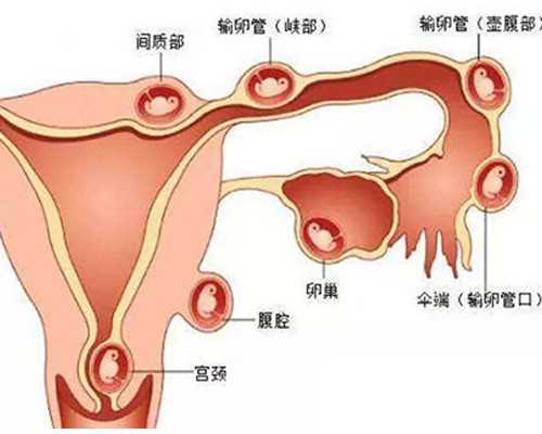 找私人可靠代妈_柬埔寨试管婴儿助孕是否能降低流产率？